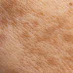 Hyperpigmentation