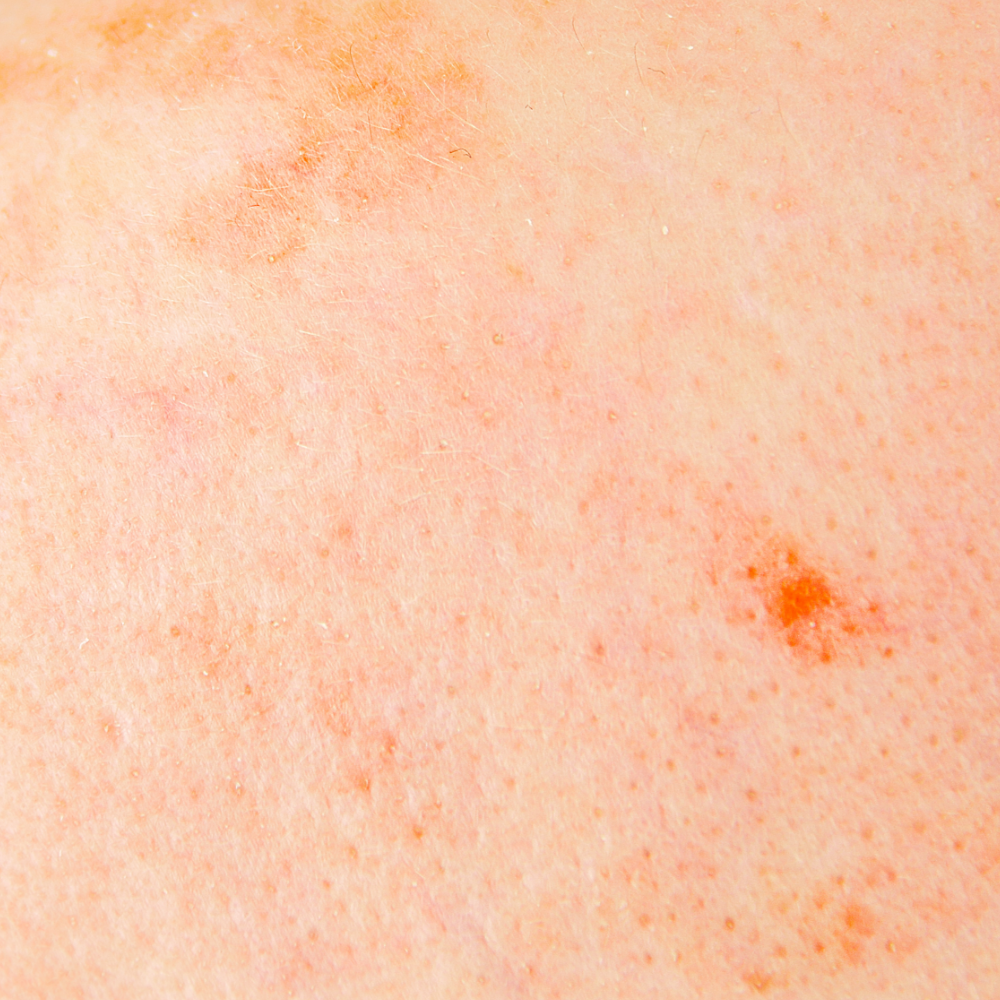 Hyperpigmented Skin