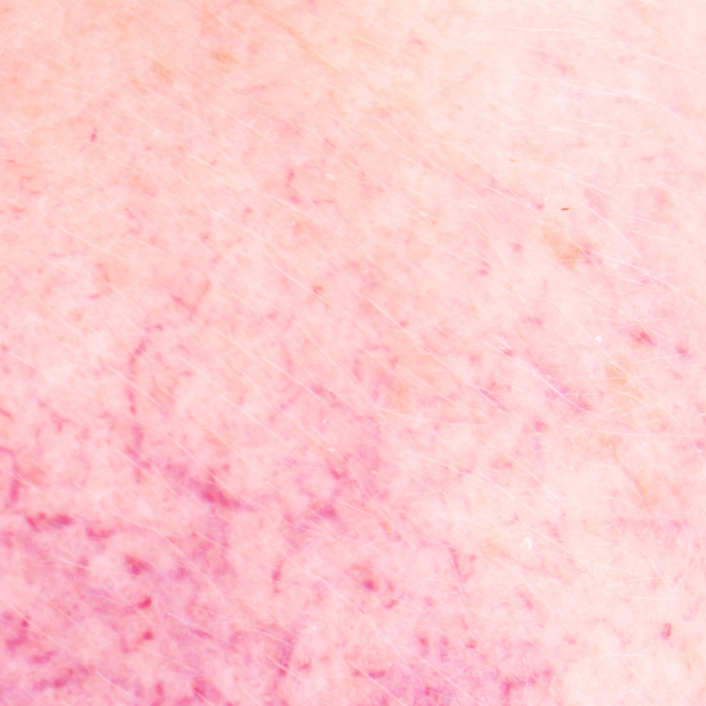 Sensitive Skin with Rosacea