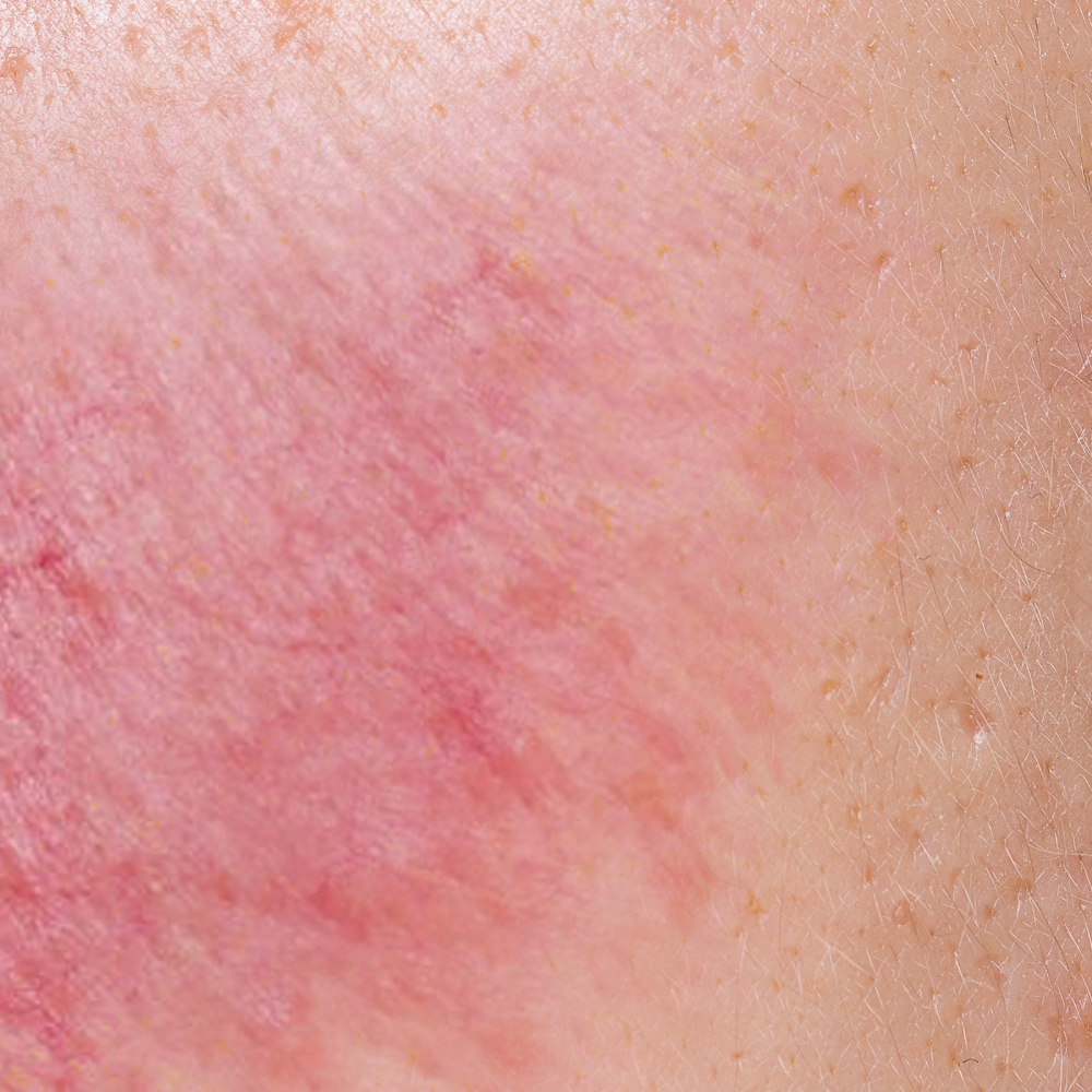 Sensitive Skin with Rosacea