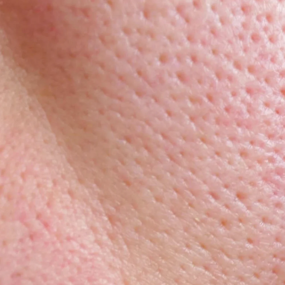Acne Prone Skin