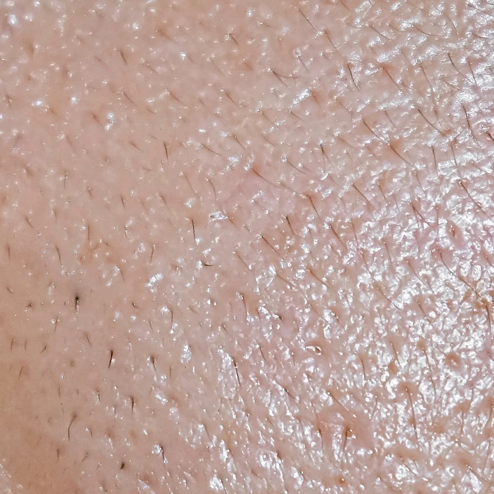 Acne Prone Skin