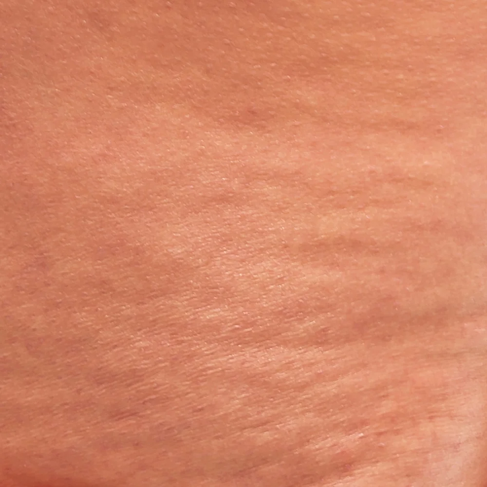 Skin with Cellulite