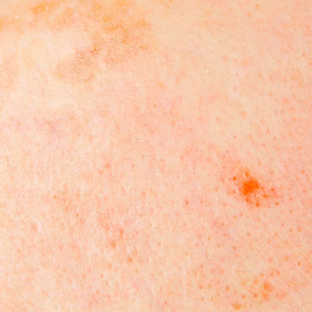 Hyperpigmented Skin