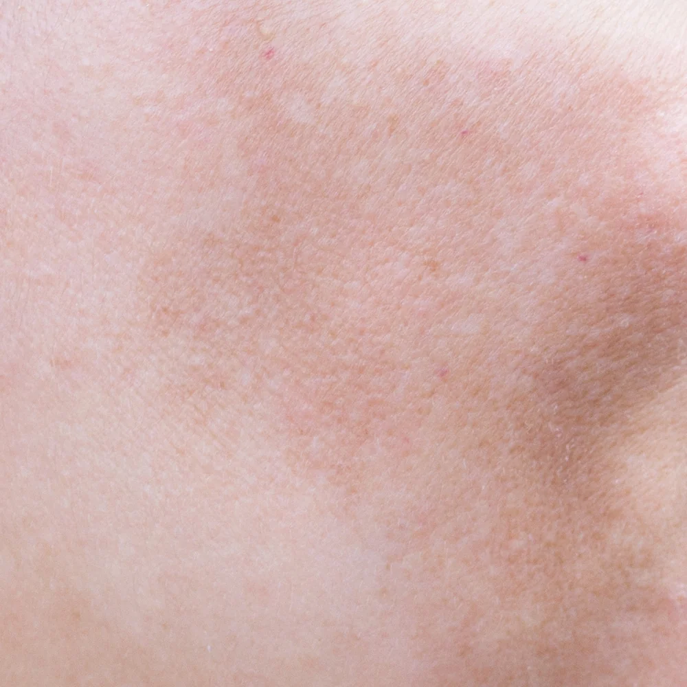 Hyperpigmented Skin