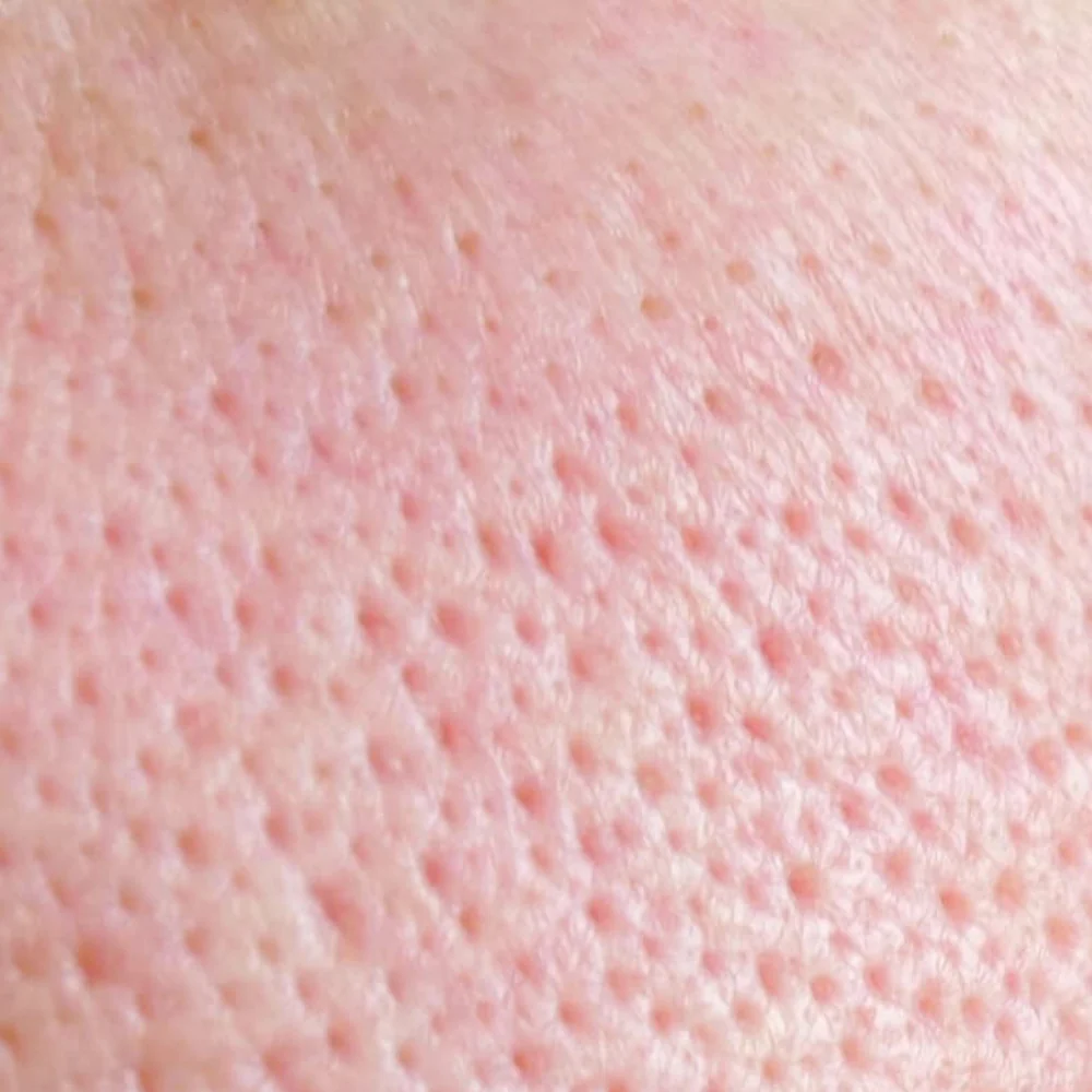 Combination Skin