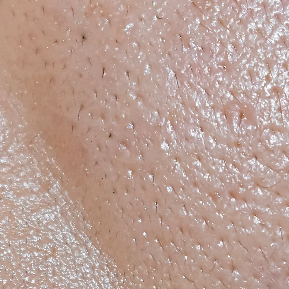 Oily Skin