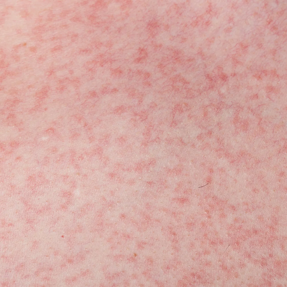 Hyper-Sensitive Skin
