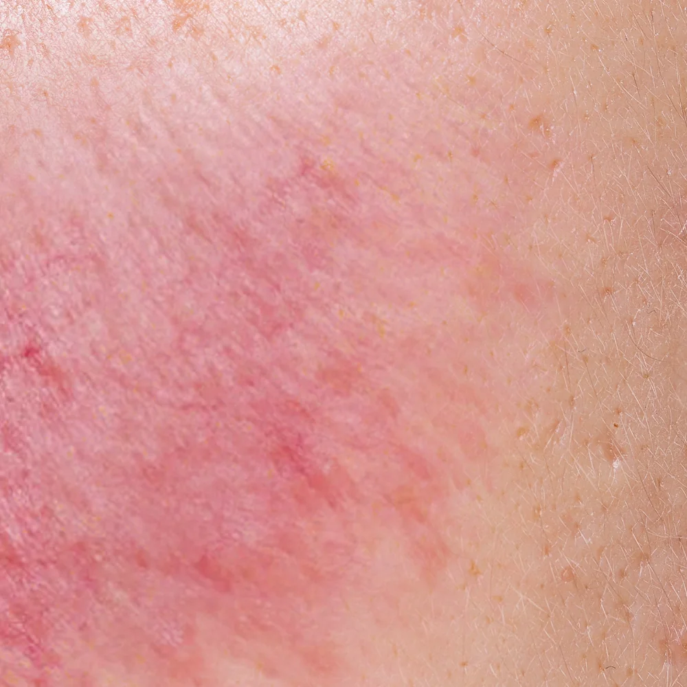 Sensitive Skin with Rosacea