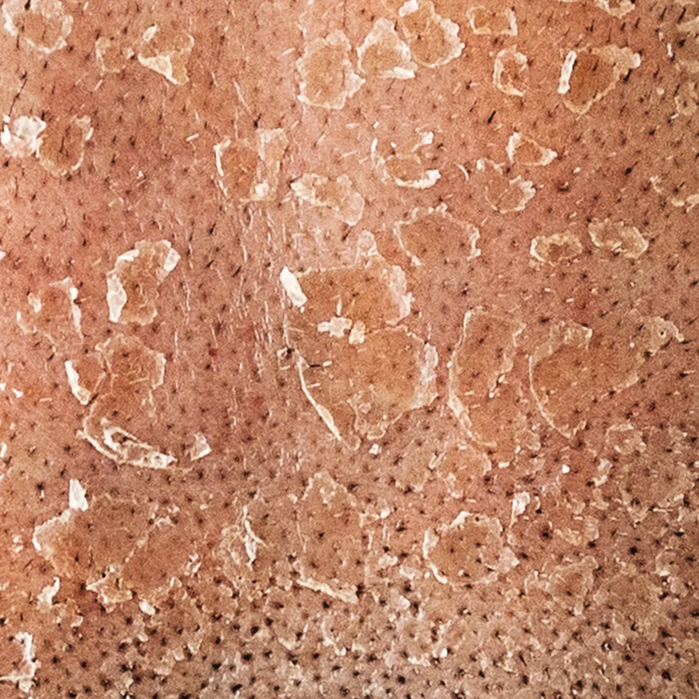 Skin with Redness and Squams