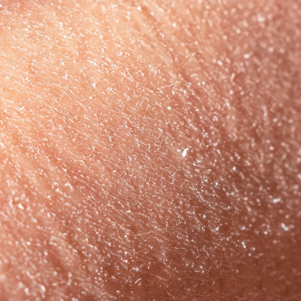 Dehydrated Skin