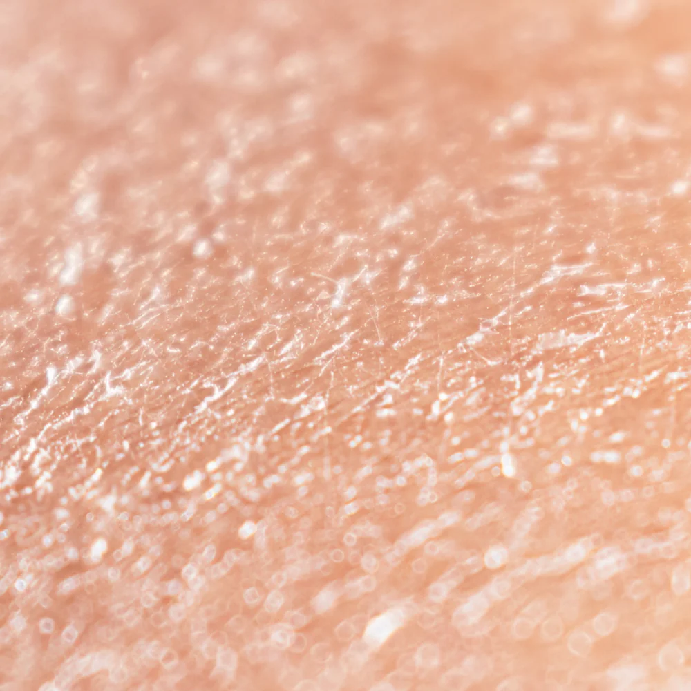 Dry skin